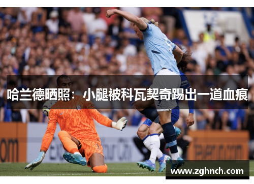 哈兰德晒照：小腿被科瓦契奇踢出一道血痕